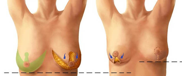 Mastopessi