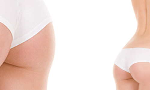 gluteoplastica