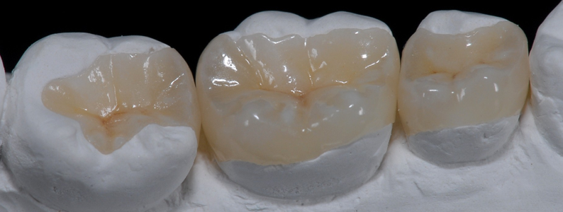 Intarsi dentali