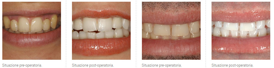 sbiancamento-dentale