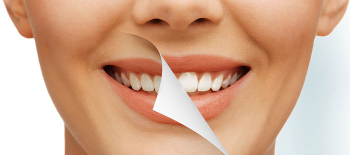 Sbiancamento dentale
