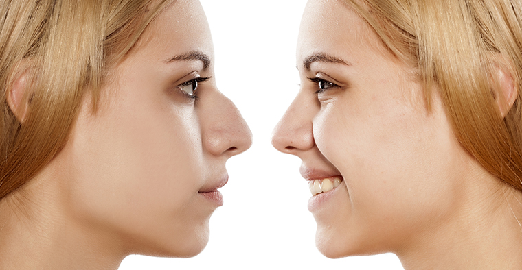 rhinoplasty